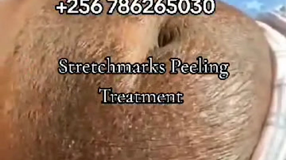 Stretchmarks Peeling Treatment